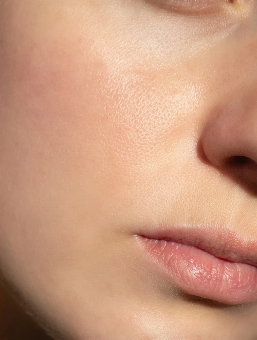 After Cystic Acne Treatment