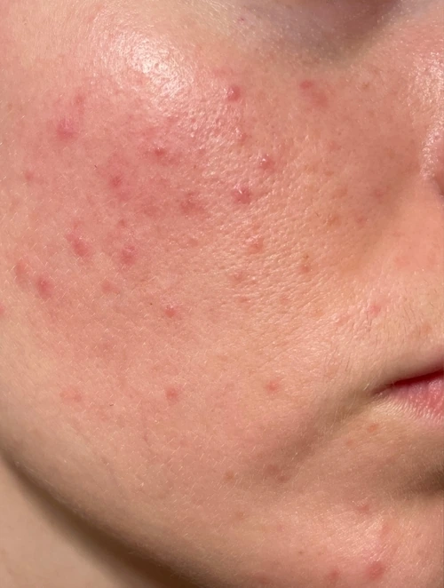 Before Cystic Acne Treatment